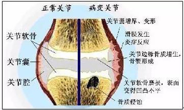 关于膝关节:烦人的“膝盖积水”到底从哪儿来?