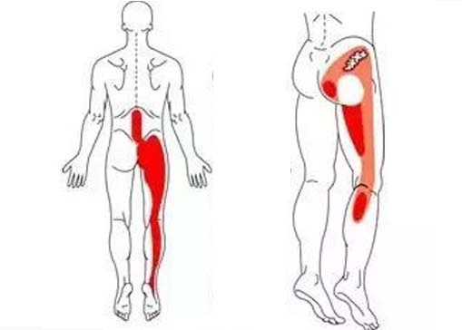 坐骨神经痛越来越常见发，其发病原因都有哪些呢？