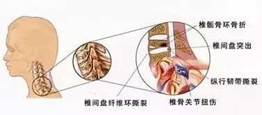 杭州余杭根志堂中医医院--走出颈椎病的诊治误区，科学预防颈椎病